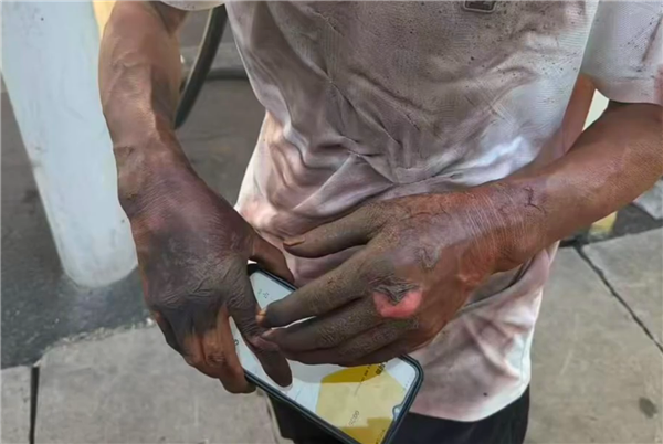 男子不断电硬拔充电枪 双手被电焦黑皮都破了